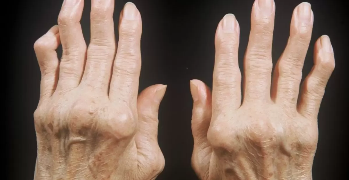 Rheumatoid Arthritis, A Comprehensive Guide