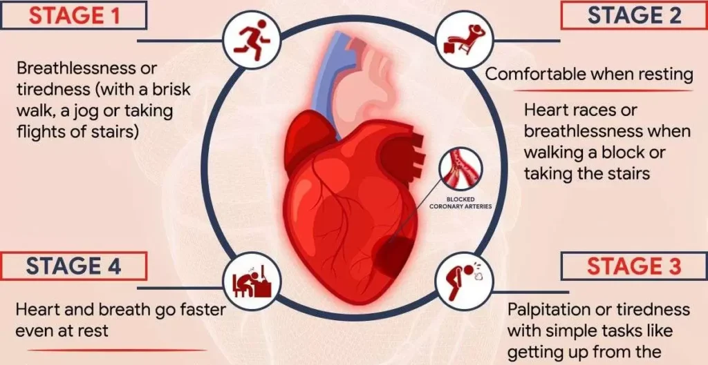 What are the 4 stages of heart failure?