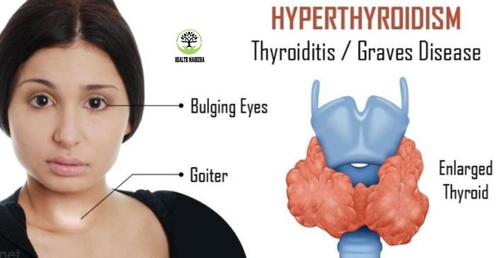 Effects of Hyperthyroidism