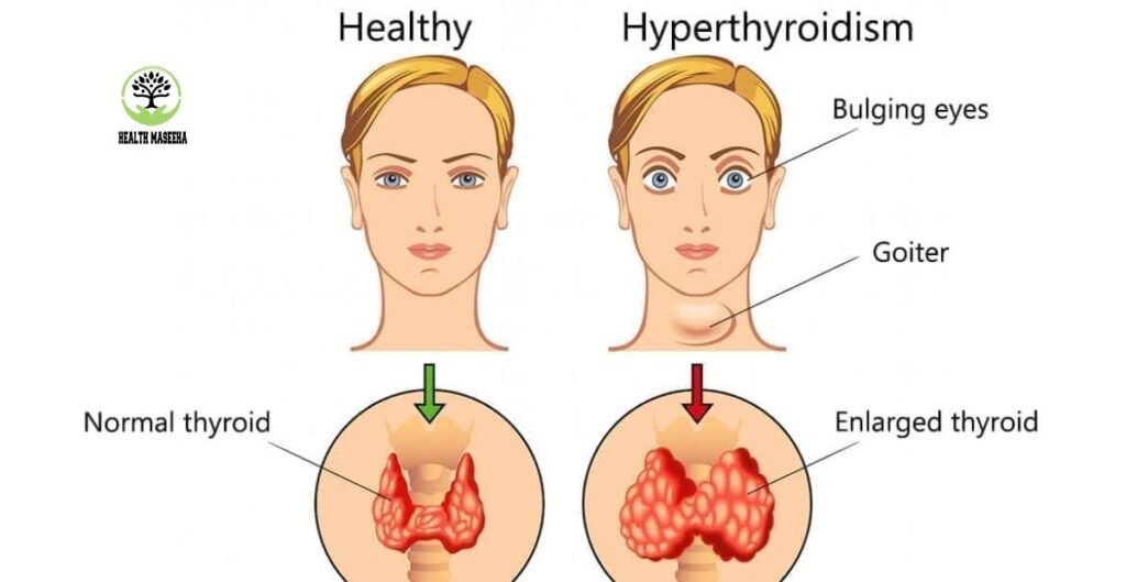 Exploring Indications of Hyperthyroidism