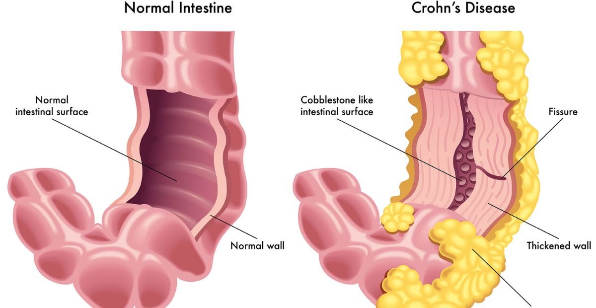 Common problems with Crohn's Disease