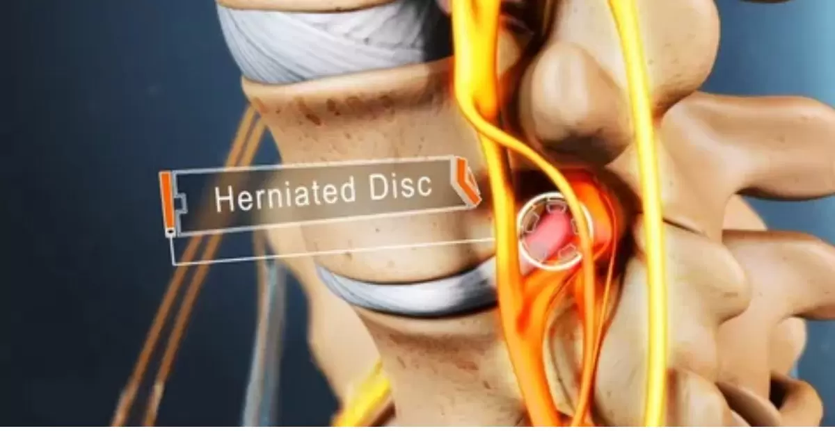 Herniated Disc Treatment: Complete Guide