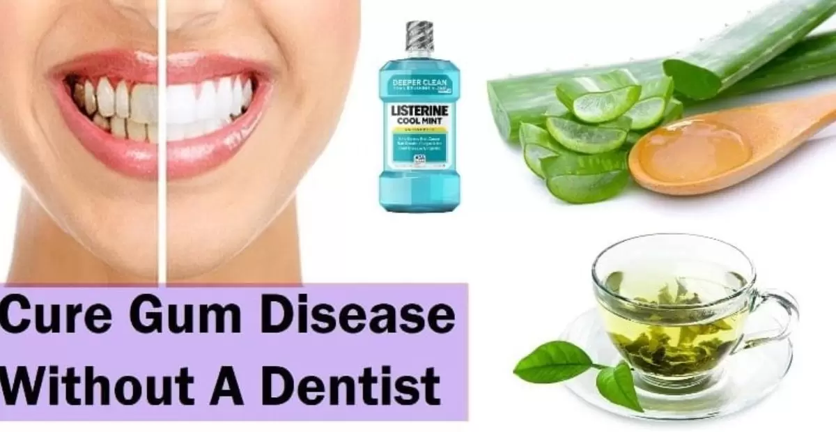 How To Cure Gum Disease Without A Dentist?