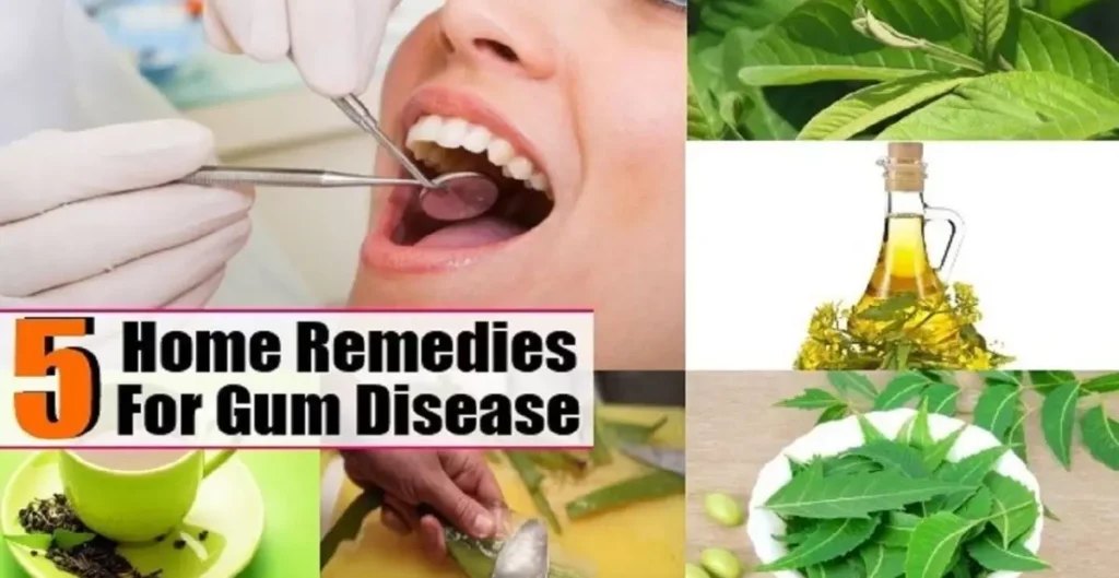 Natural Remedies for Gum Disease