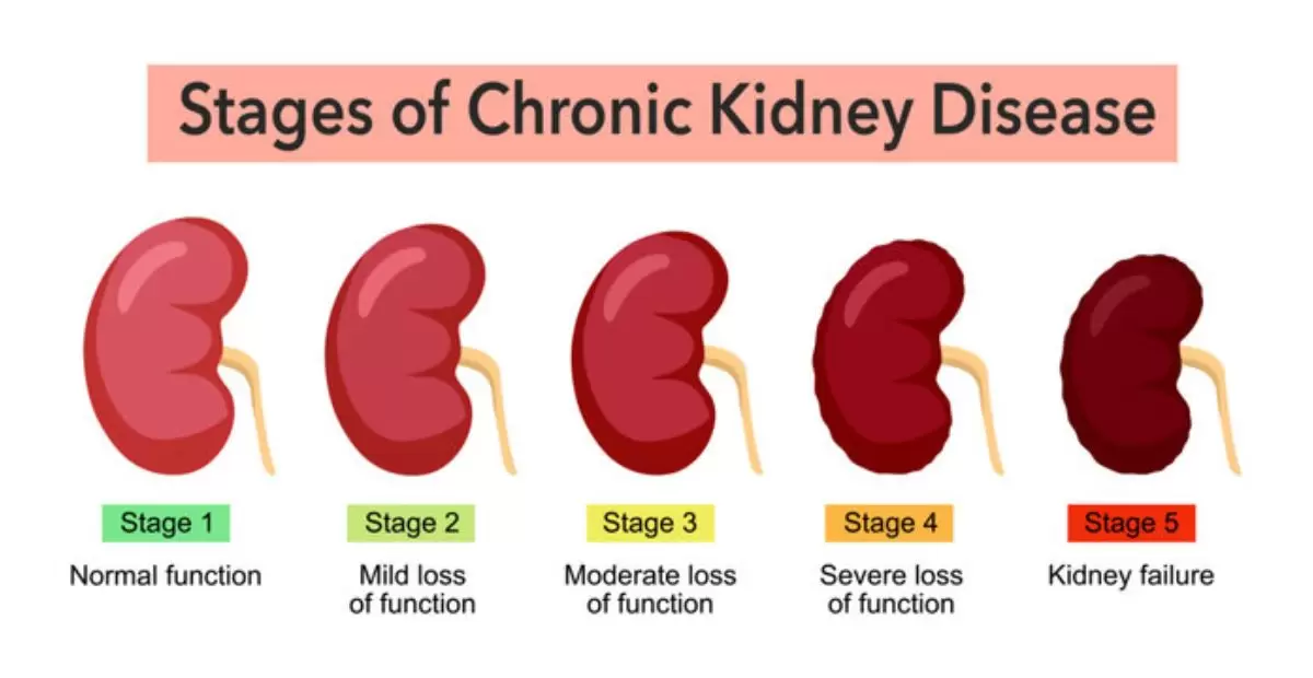 Stages of Chronic Kidney Disease 