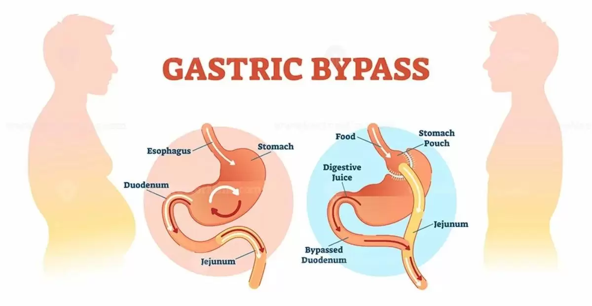 The Best Surgeon For Gastric Bypass Surgery