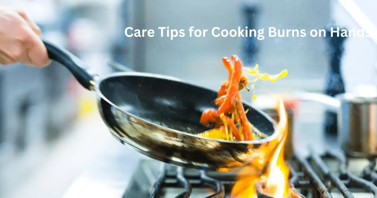 Immediate Care Tips for Cooking Burns on Hands