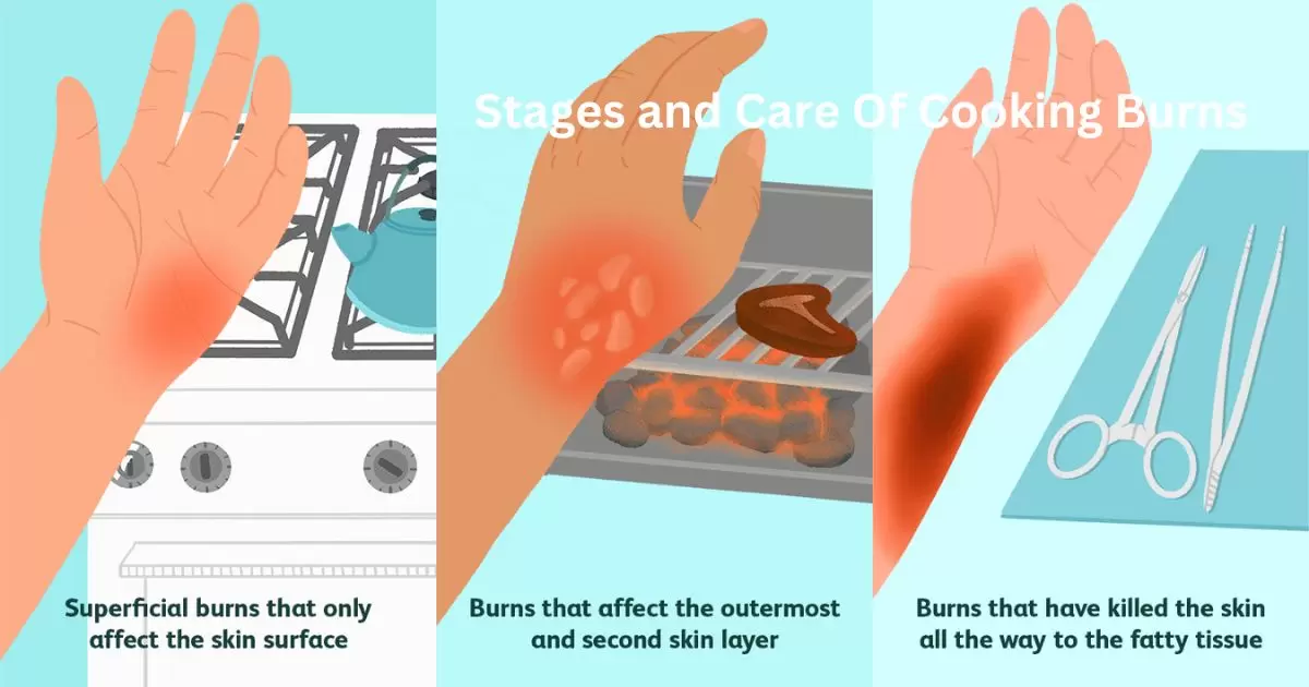 Stages and Care Of Cooking Burns